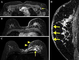 A breast mri captures multiple images of your breast. Mri Findings Of Inflammatory Breast Cancer Locally Advanced Breast Cancer And Acute Mastitis T2 Weighted Images Can Increase The Specificity Of Inflammatory Breast Cancer Springerlink