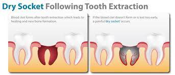 When can a patient vape after extraction? How Long Are You Susceptible To Dry Socket After Wisdom Teeth Removal Quora