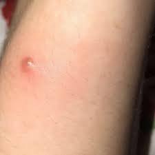 Image result for spinne biss haut reaktion