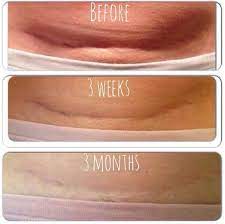 You will have a scar but this will fade over time. Pin On Itworks It Really Does