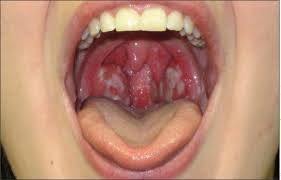 Image result for Pharyngitis