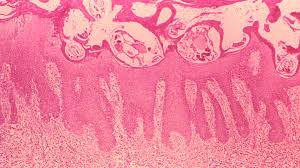Find patient medical information for ivermectin oral on webmd including its uses, side effects and safety, interactions, pictures, warnings and user ratings. Scabioral Vorerst Wieder Lieferbar Apotheke Adhoc