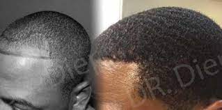 Hair transplants for african american hair hair transplant on those of african american descent is more difficult than caucasian or asian ethnicities due to the curly hair and root. What To Know About African American Hair Transplants Hair Transplant