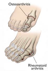 A bone spur on top of your foot can happen in many different areas. Arthritis Of The Foot And Ankle Orthoinfo Aaos