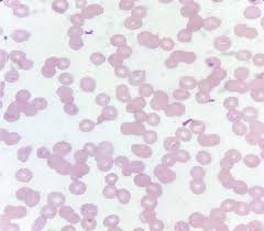 Image result for Peripheral Smear