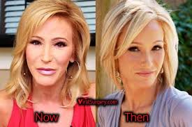 A celebrity that rumored to get the treatment is paula white. Paula White Plastic Surgery Before And After Facelift Pictures