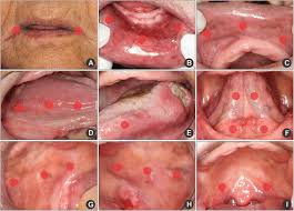Image result for spinocellular carcinoma of the oral cavity