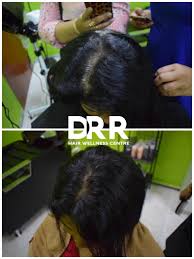 Penyebab rambut beruban di usia muda beragam, namun keberadaan uban di kepala memang menjengkelkan. Testimoni Rambut Uban Dr R Hair Wellness