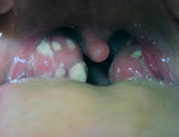 Sweet but not cloyingly so, like the frankincense burned in those smoking, swinging thuribles at sunday service. Tonsillitis Symptoms Pictures Causes And Treatment