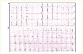 Left ventricular hypertrophy with secondary repolarization abnormalities as seen on ecg. Electrocardiographic Right Ventricular Hypertrophy A 12 Lead Download Scientific Diagram