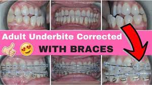 How much overbite is normal. No More Underbite Adult Underbite Corrected With Braces And M E A W Technique Wires Youtube