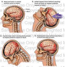Whiplash Traumatic Closed Head Injury Head Injury Whiplash Injury Traumatic Brain Injury