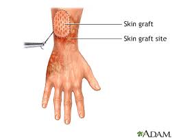 نتیجه جستجوی لغت [graft] در گوگل
