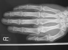 The noise when a finger joint pops is caused by cavitation of the fluid lubricating the joint. Finger Mp Joint Hand To Elbow