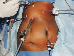 Abdominal exploration (laparoscopic or open); Thoraco Laparoscopic Ivor Lewis Esophagectomy The Most Extensive Indian Experience