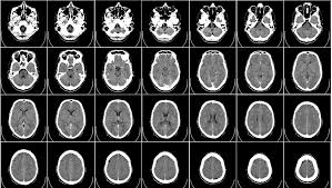 Regular assessment of a patient's gcs can identify. Gcs Remastered Recent Updates To The Glasgow Coma Scale Gcs P Emottawa Blog
