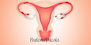 Most often this is on the ovaries, fallopian tubes, and tissue around the uterus and ovaries; Endometriosis What It Is And Questions To Ask Wilcox Fertility Pasadena Fertility Doctor