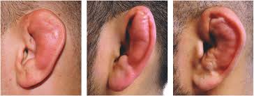 Why are there no aikido practitioners in mma? Cauliflower Ear In Bjj Mma Ufc And Wrestling Bjj Galaxy