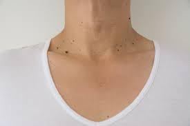 Como Quitar Las Verrugas Del Cuello Descubrelo