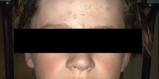 This can cause facial hair, as can prescription strength androgens (male hormones) like testosterone. Kids Are Getting Acne Younger Than Ever Doctors Say