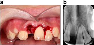 Image result for Tooth Avulsion