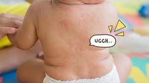 Apabila seseorang mempunyai virus ini. Terlihat Mirip Begini Cara Membedakan Penyakit Campak Dan Roseola Pada Bayi Orami