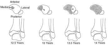 Ankle Fractures Pediatric Pediatrics Orthobullets