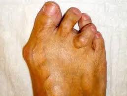 Image result for Hammer toe