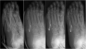 Fracture healing occurs naturally after traumatic bony disruption. Effect Of Weight Bearing In Conservative And Operative Management Of Fractures Of The Base Of The Fifth Metatarsal Bone