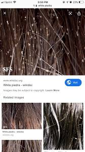 Image result for lice vs dandruff