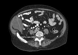 Most tumors arise from the pleura, and so this article will focus on pleural mesothelioma. Cureus Benign Multicystic Peritoneal Mesothelioma Presenting As A Colonic Mass
