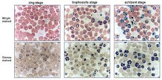 Image result for Peripheral Smear