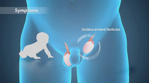 Image result for Undescended Testicle