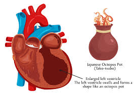 Image result for Cardiomyopathy