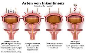 Formen Und Ursachen Von Inkontinenz