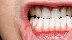 3 how to prevent maintain good oral hygiene and check for gingivitis symptoms regularly. What You Need To Know About Gum Disease Everyday Health