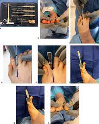 Minimally Invasive Intermetatarsal Nerve Decompression For Morton S Neuroma A Review Of 27 Cases The Journal Of Foot And Ankle Surgery