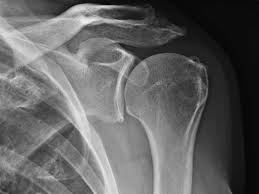 Image result for Shoulder XRay