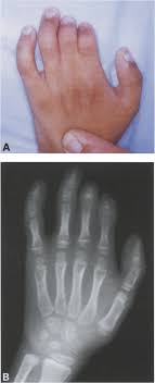 Poland syndrome is characterized by an underdeveloped or absent chest muscle on one side of the body, absence of the breastbone portion. Http Www Jprasurg Com Article S0007 1226 00 93505 7 Pdf