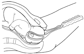 Image result for Forceps Assisted Delivery