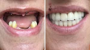 We did not find results for: Dental Implant Costs In The Uk Abroad Qunomedical