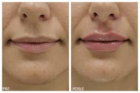 Ali postoje trenuci kada ne možete bez stručnog savjeta: Uvecanje Usana Hijaluronskim Filerima Estetika Dr Jeremic