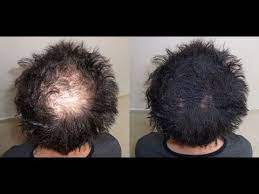 These remedies will also help you if you are looking to regrow hair on a bald spot or if you are looking to experience some hair regrowth. This Mixture May Take You From Bald To Thick Hair No Edges To Edges Bald Spots To Having Hair Youtube Regrow Hair Thick Hair Remedies Regrow Hair Naturally