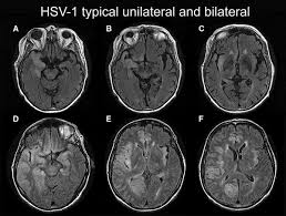 Encephalitis refers to an acute, usually diffuse, inflammatory process affecting the brain. Predictors Of Outcome In Hsv Encephalitis Springerlink