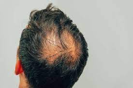 Como Recuperar El Cabello Perdido Capilclinic