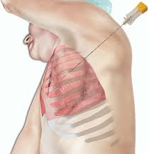 Lung Biopsy 