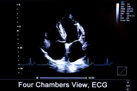 Image result for Point of Maximum Impulse