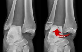 Image result for Ankle Dislocation