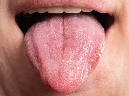 Image result for white cancer on tongue)