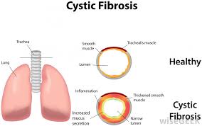Cystic fibrosis (cf) is an autosomal recessive genetic disorder that affects the lungs, pancreas, liver, intestine, and reproductive organs. What Is A Cystic Fibrosis Vest With Pictures